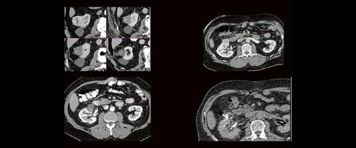 Thermoablation von Nierentumoren (Webinar | Online)