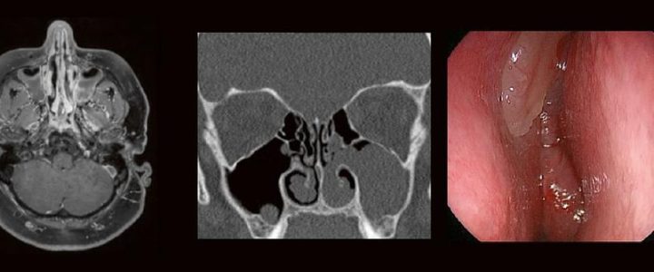 HNO & Radiologie: gemeinsam durch die NNH – ein Joint Venture (Webinar | Online)